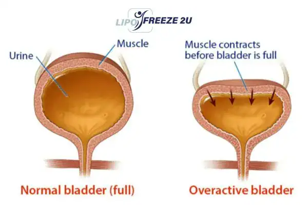 diagram of overactive bladder treatment Dartford