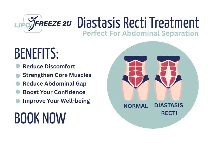 How Long Will It Take to See Improvements in Diastasis Recti Dartford
