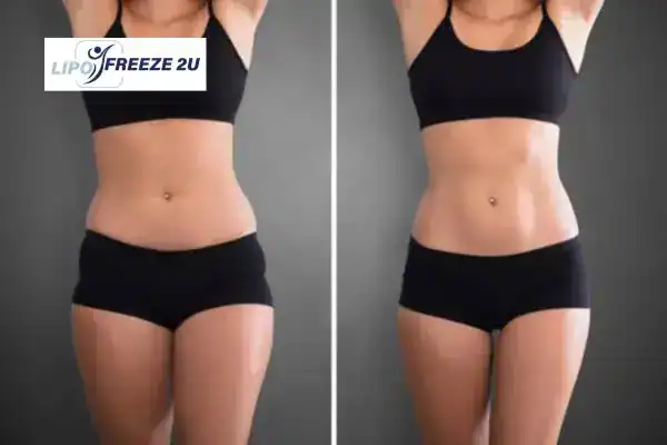 How Can LIPO FREEZE 2U Support Your Post-Pregnancy Body Recovery Dartford?
