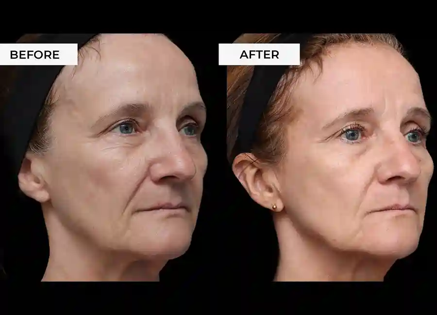 How Many RF Microneedling Sessions Will You Need to See a Difference Dartford?