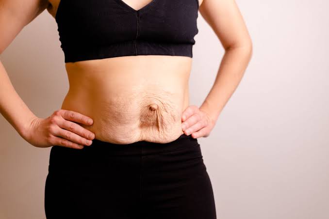 Is Surgery Really the Only Way to Repair Diastasis Recti Dartford?