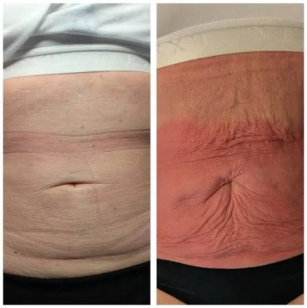 How Does RF Microneedling Improve Crepey, Thin and Uneven Skin Texture Dartford?