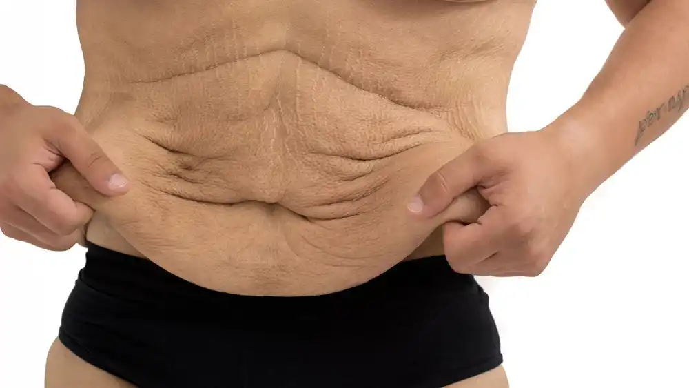 Why Does Weight Loss Medication Leave Some People With Loose or Sagging Skin Dartford?